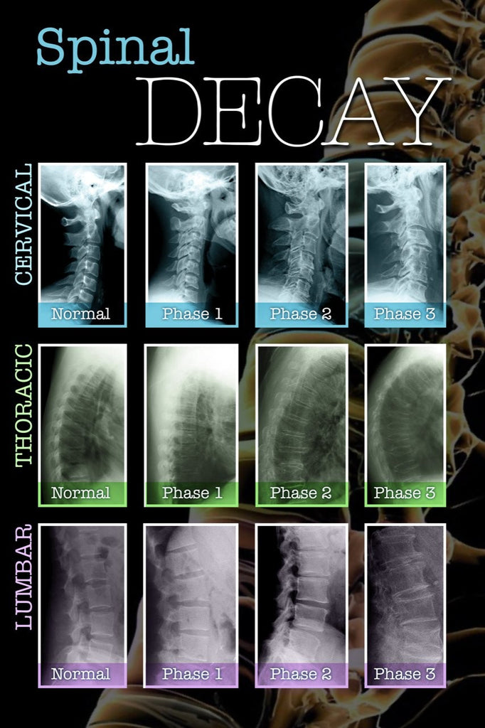 Spinal Decay Wall Decal Poster