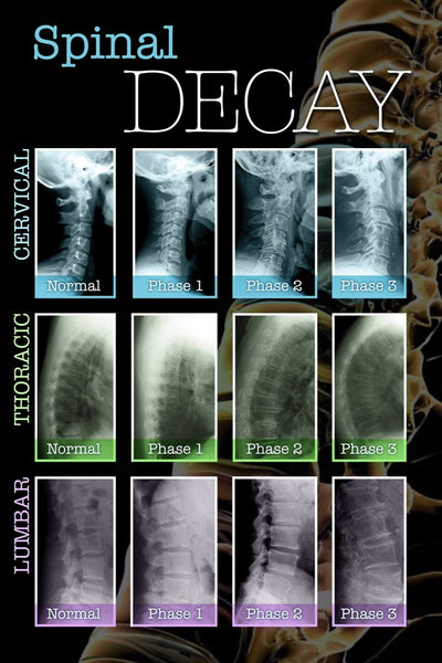 Spinal Decay Wall Decal Poster